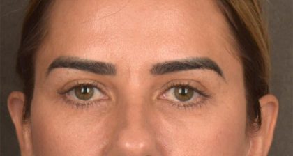 Blepharoplasty Before & After Patient #3136