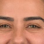 Blepharoplasty Before & After Patient #3136