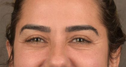 Blepharoplasty Before & After Patient #3136