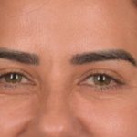 Blepharoplasty Before & After Patient #3136