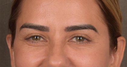 Blepharoplasty Before & After Patient #3136