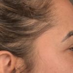Blepharoplasty Before & After Patient #3136