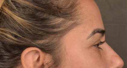 Blepharoplasty Before & After Patient #3136