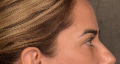Blepharoplasty Before & After Patient #3136