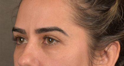 Blepharoplasty Before & After Patient #3136
