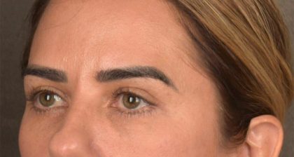 Blepharoplasty Before & After Patient #3136