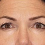 Blepharoplasty Before & After Patient #3137