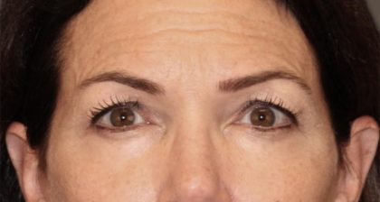 Blepharoplasty Before & After Patient #3137