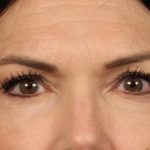 Blepharoplasty Before & After Patient #3137