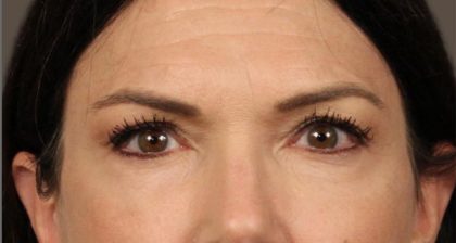 Blepharoplasty Before & After Patient #3137