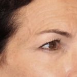 Blepharoplasty Before & After Patient #3137