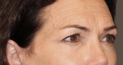 Blepharoplasty Before & After Patient #3137