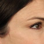 Blepharoplasty Before & After Patient #3137