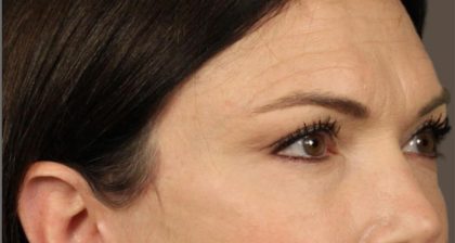 Blepharoplasty Before & After Patient #3137