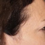 Blepharoplasty Before & After Patient #3137