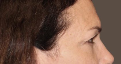 Blepharoplasty Before & After Patient #3137