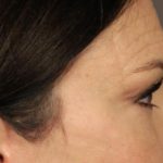 Blepharoplasty Before & After Patient #3137
