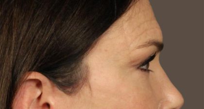 Blepharoplasty Before & After Patient #3137