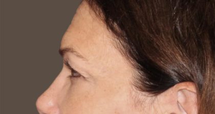 Blepharoplasty Before & After Patient #3137