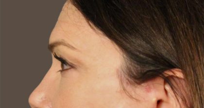 Blepharoplasty Before & After Patient #3137