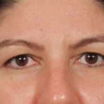 Blepharoplasty Before & After Patient #3139