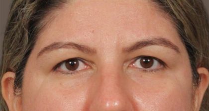 Blepharoplasty Before & After Patient #3139