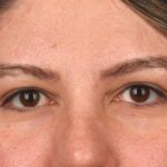 Blepharoplasty Before & After Patient #3139