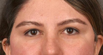 Blepharoplasty Before & After Patient #3139