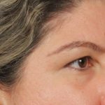 Blepharoplasty Before & After Patient #3139