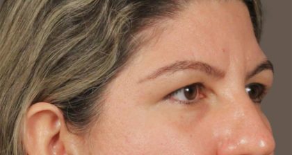 Blepharoplasty Before & After Patient #3139
