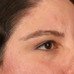 Blepharoplasty Before & After Patient #3139