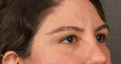 Blepharoplasty Before & After Patient #3139
