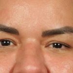 Blepharoplasty Before & After Patient #3140