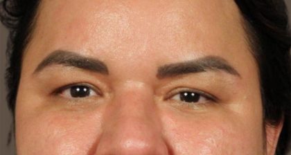 Blepharoplasty Before & After Patient #3140