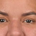 Blepharoplasty Before & After Patient #3140