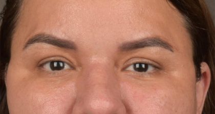 Blepharoplasty Before & After Patient #3140