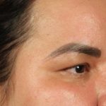 Blepharoplasty Before & After Patient #3140