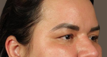 Blepharoplasty Before & After Patient #3140