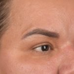 Blepharoplasty Before & After Patient #3140