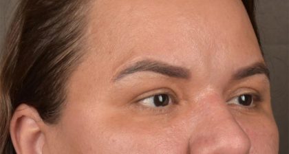 Blepharoplasty Before & After Patient #3140
