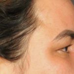 Blepharoplasty Before & After Patient #3140