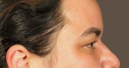 Blepharoplasty Before & After Patient #3140