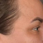 Blepharoplasty Before & After Patient #3140
