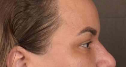 Blepharoplasty Before & After Patient #3140