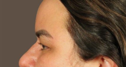 Blepharoplasty Before & After Patient #3140