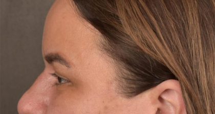 Blepharoplasty Before & After Patient #3140