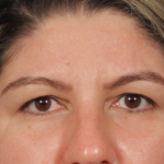 Brow Lift Before & After Patient #3419