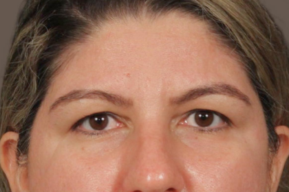 Brow Lift Before & After Patient #3419