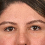 Brow Lift Before & After Patient #3419