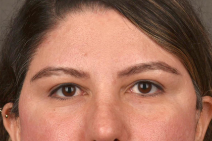 Brow Lift Before & After Patient #3419